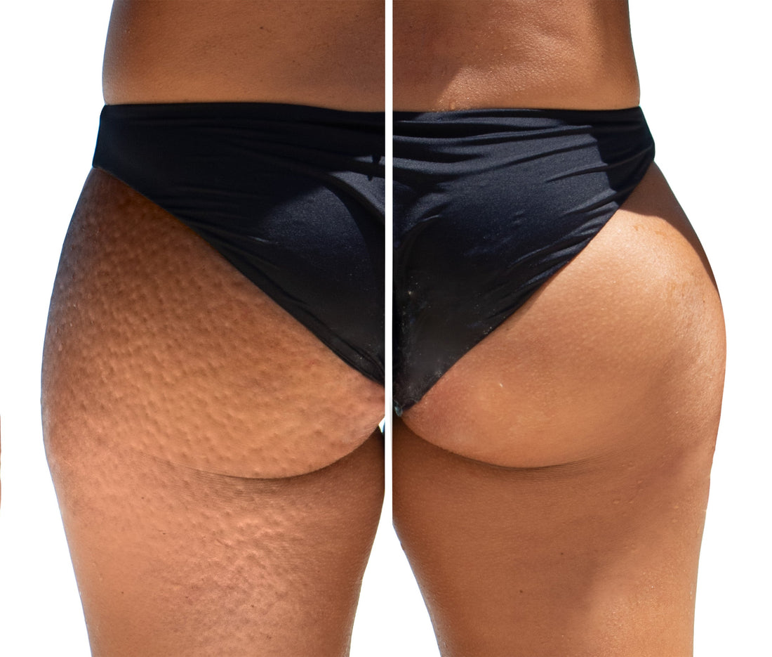Can Cellulite Decrease Every Day by Taking 10,000mg of Beef Collagen? A Comprehensive Look