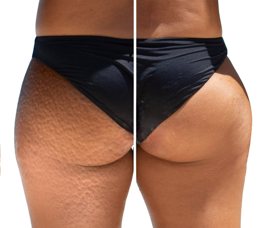 Can Cellulite Decrease Every Day by Taking 10,000mg of Beef Collagen? A Comprehensive Look